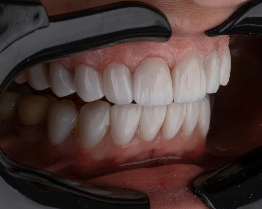 CASO 01 — Lentes de contato dental
