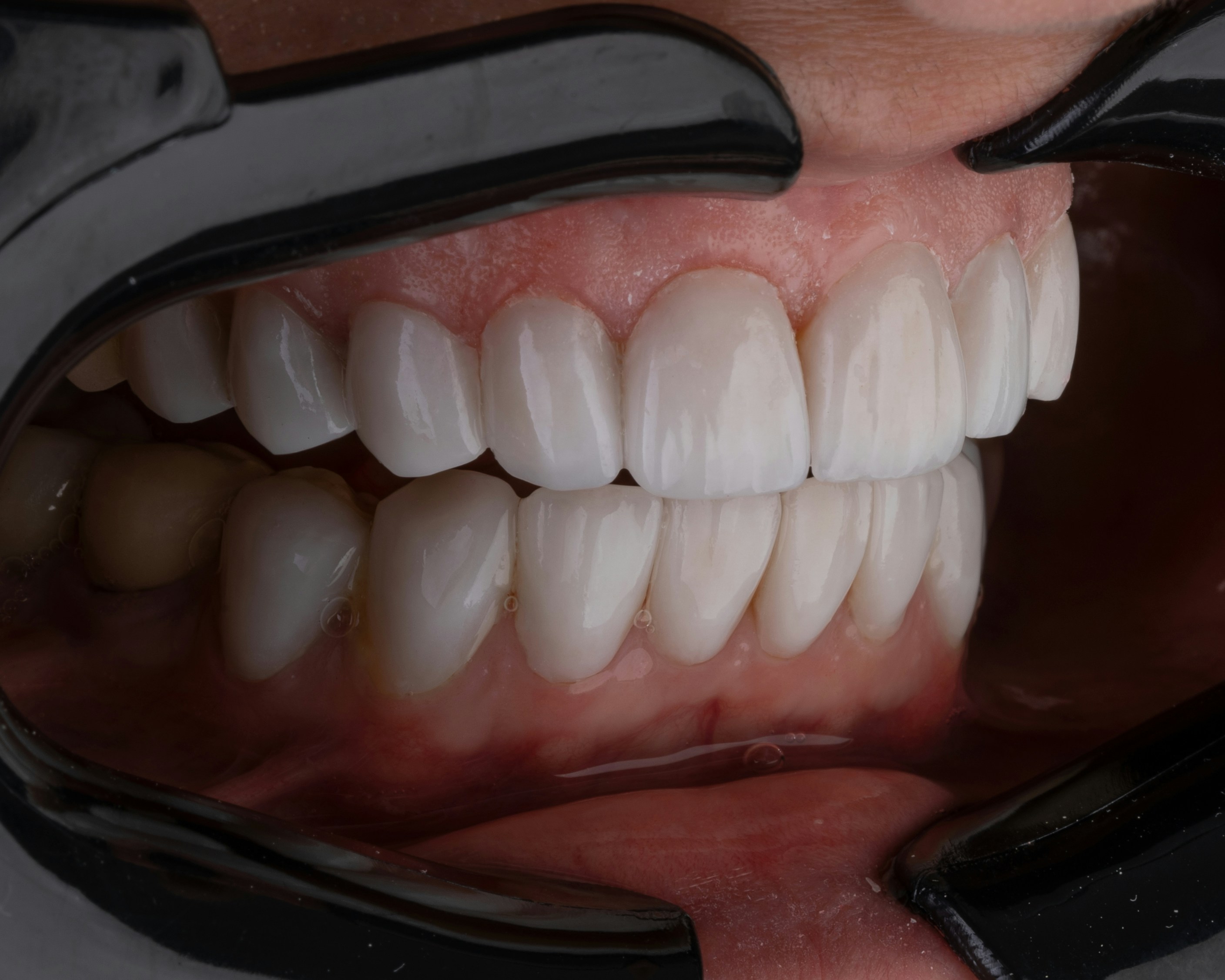 Lentes de contato dental — avaliação clínica